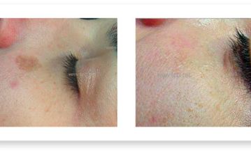 Medicina Estética Dra. Mary Carmen Sánchez Moreno Tratamiento plexr
