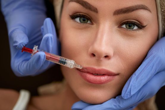 Mujer inyectándose acido hialuronico en labios